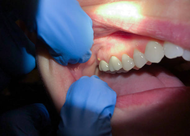 Best Emergency Treatment for Dental Infections or Abscesses in Enumclaw, WA