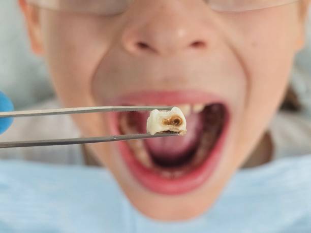 Best Emergency Dental Care for Broken or Chipped Teeth in Enumclaw, WA